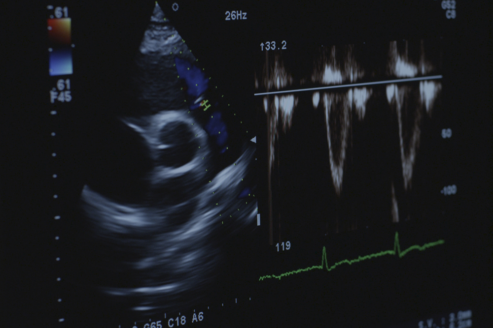 ecocardiografia aviles